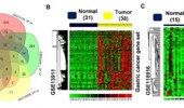 Amplified gene expressions were implicated in the gastric carcinogenesis of the intestinal subtype