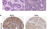 Multi-database analysis of BRCA1 and GATA3 reveals distinct molecular features and prognostic significance in breast cancer